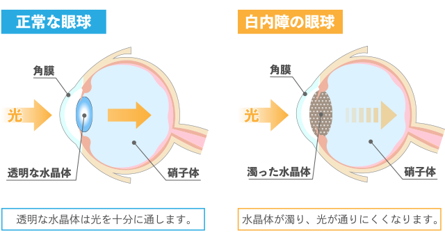 白内障とは