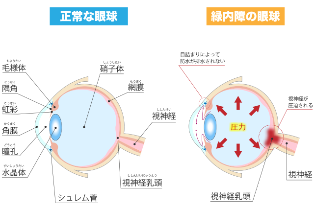 緑内障とは